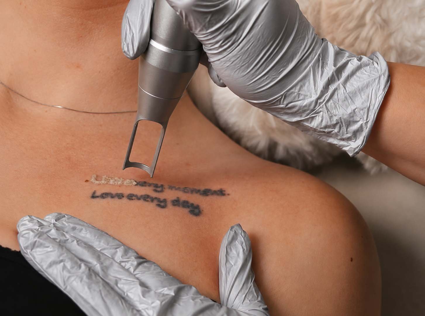 Tattoo verwijderen laser