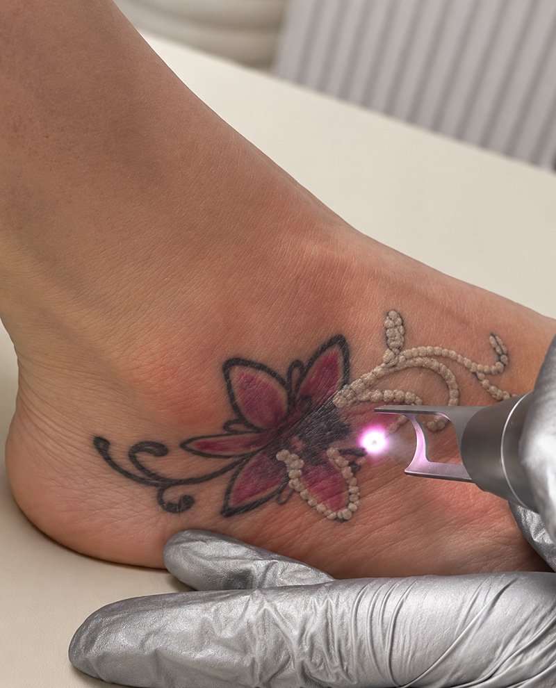 tattoo verwijderen laser